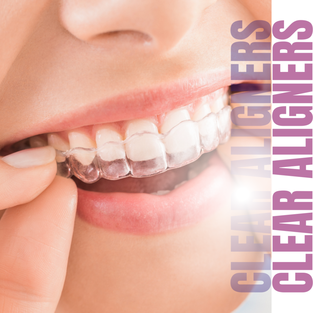 Clear Aligner